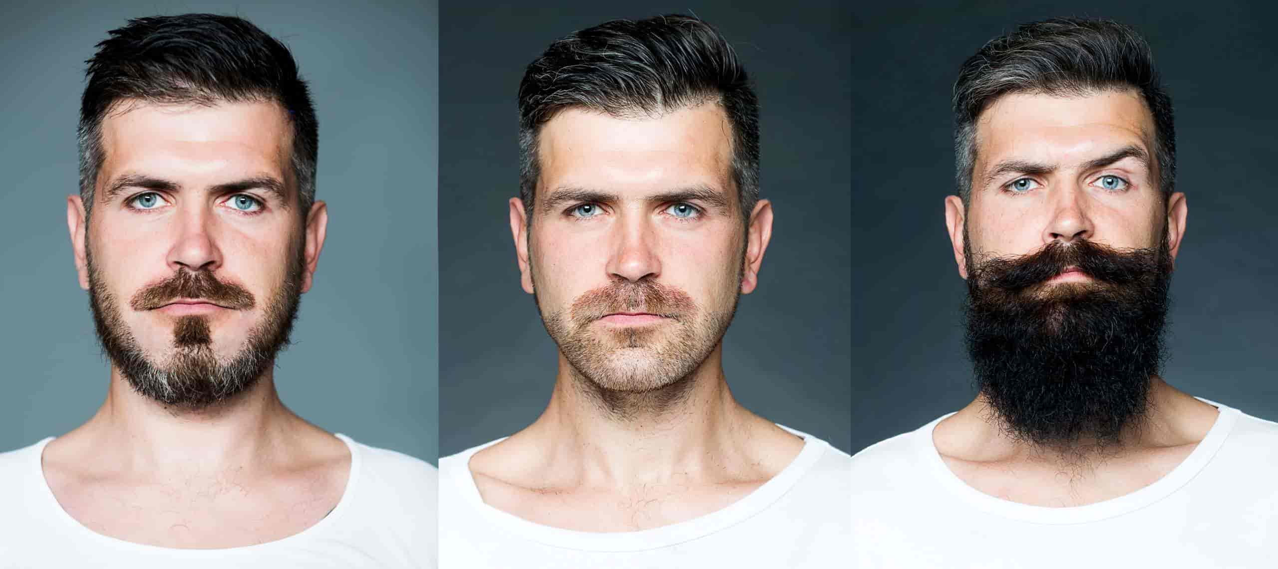 Cos'è il Trapianto di Barba
