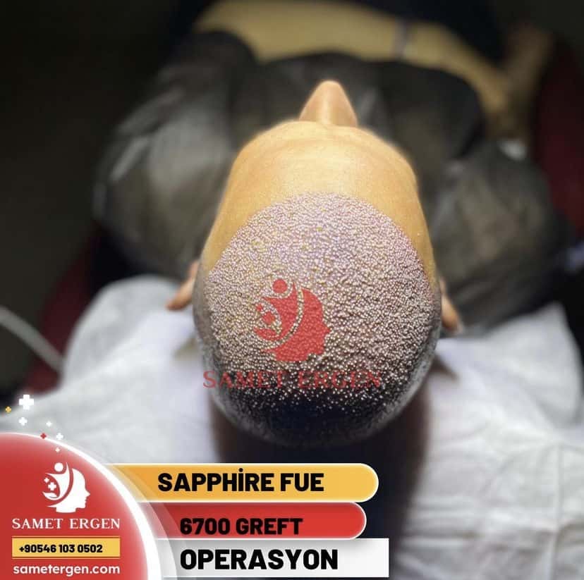 Sapphire FUE - 5100 Greft