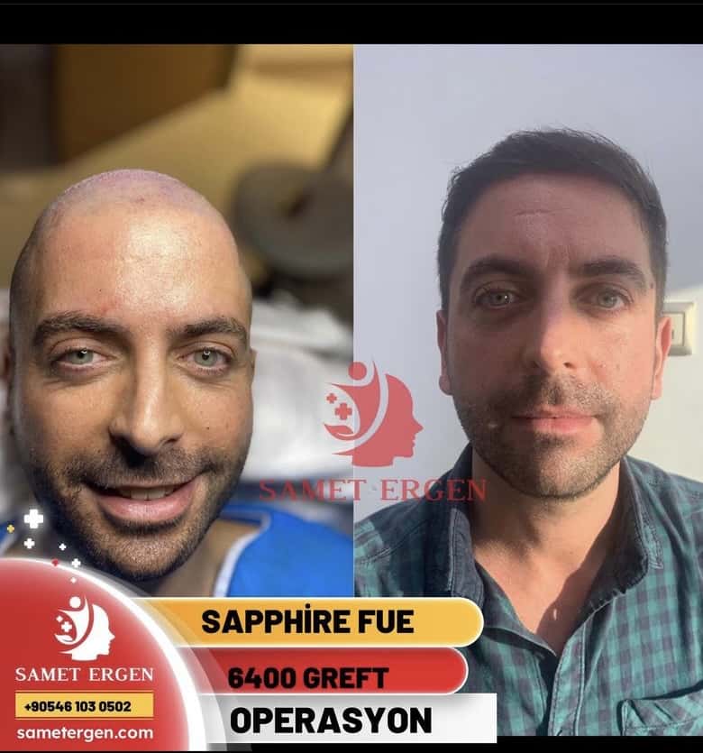 Sapphire FUE - 6400 Greft Operation