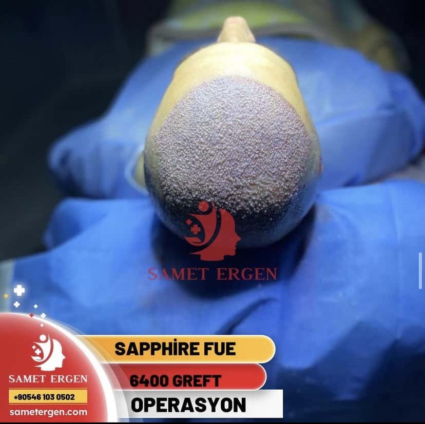 Sapphire FUE - 6400 Greft