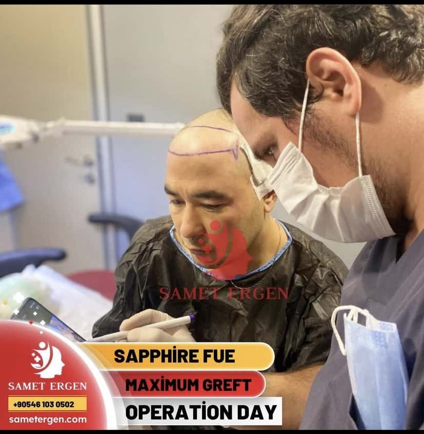 Sapphire FUE - Operation Day